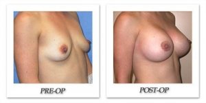 phoca_thumb_l_mandris-breast-augmentation-050