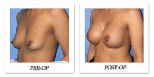 phoca_thumb_l_mandris-breast-augmentation-056