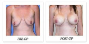 phoca_thumb_l_mandris-breast-augmentation-059