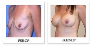 phoca_thumb_l_mandris-breast-augmentation-060