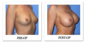 phoca_thumb_l_mandris-breast-augmentation-062