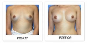 phoca_thumb_l_mandris-breast-augmentation-063