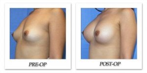 phoca_thumb_l_mandris-breast-augmentation-064