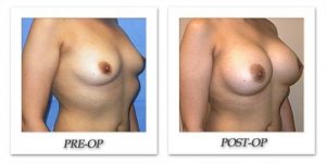 phoca_thumb_l_mandris-breast-augmentation-066