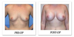 phoca_thumb_l_mandris-breast-augmentation-069