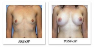 phoca_thumb_l_mandris-breast-augmentation-073