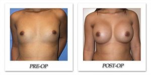 phoca_thumb_l_mandris-breast-augmentation-075