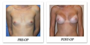 phoca_thumb_l_mandris-breast-augmentation-077