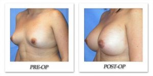 phoca_thumb_l_mandris-breast-augmentation-082