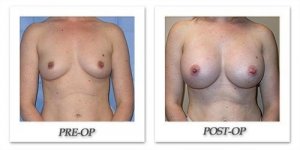 phoca_thumb_l_mandris-breast-augmentation-083