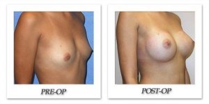 phoca_thumb_l_mandris-breast-augmentation-088