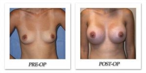 phoca_thumb_l_mandris-breast-augmentation-089
