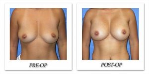 phoca_thumb_l_mandris-breast-augmentation-091