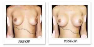 phoca_thumb_l_mandris-breast-augmentation-095