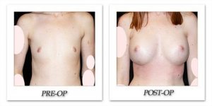 phoca_thumb_l_mandris-breast-augmentation-097