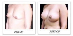 phoca_thumb_l_mandris-breast-augmentation-100