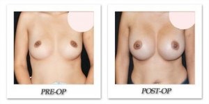 phoca_thumb_l_mandris-breast-augmentation-103