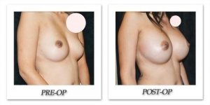 phoca_thumb_l_mandris-breast-augmentation-104