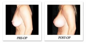 phoca_thumb_l_mandris-breast-augmentation-106