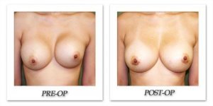 phoca_thumb_l_before-after-001