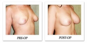 phoca_thumb_l_before-after-005