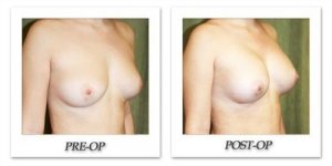 phoca_thumb_l_before-after-008