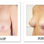 Breast Lift | Reduction