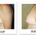 Breast Lift | Reduction