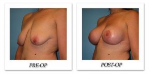 phoca_thumb_l_bruno-breast-lift-005
