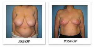 phoca_thumb_l_bruno-breast-reduction-001