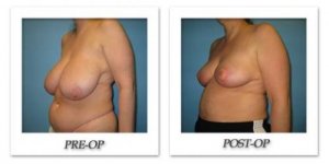 phoca_thumb_l_bruno-breast-reduction-002