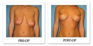 phoca_thumb_l_bruno-breastreduction-006