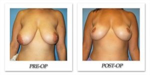 phoca_thumb_l_bruno-breastreduction-007