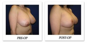 phoca_thumb_l_cohen-breast-reduction-002