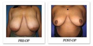phoca_thumb_l_cohen-breast-reduction-003
