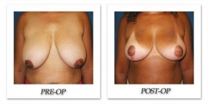 phoca_thumb_l_cohen-breast-reduction-007