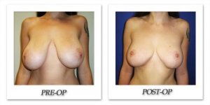 phoca_thumb_l_cohen-breast-reduction-008
