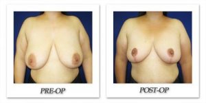 phoca_thumb_l_cohen-breast-reduction-010
