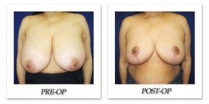 phoca_thumb_l_cohen-breast-reduction-012