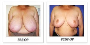 phoca_thumb_l_cohen-breast-reduction-014