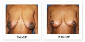 phoca_thumb_l_cohen-breast-reduction-017