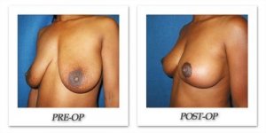 phoca_thumb_l_cohen-breast-reduction-018