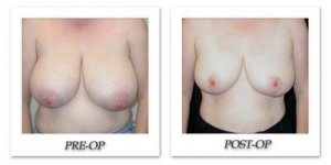 phoca_thumb_l_mandris-breast-reduction-005