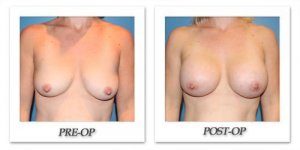 phoca_thumb_l_breastaugmentation2016