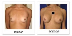 phoca_thumb_l_cohen-breast-augmentation-001