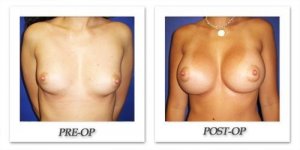 phoca_thumb_l_cohen-breast-augmentation-015
