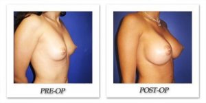 phoca_thumb_l_cohen-breast-augmentation-016