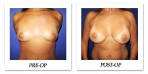phoca_thumb_l_cohen-breast-augmentation-019