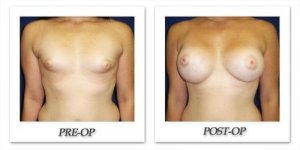 phoca_thumb_l_cohen-breast-augmentation-023
