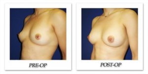 phoca_thumb_l_cohen-breast-augmentation-030